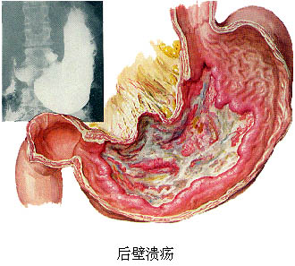 常吃夜宵会导致胃溃疡吗